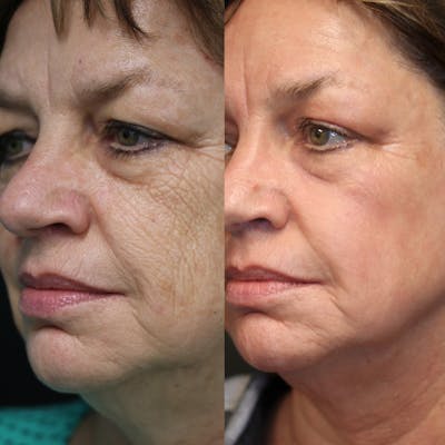 ÔPTIMized Laser Cocktail Before & After Gallery - Patient 77043931 - Image 1