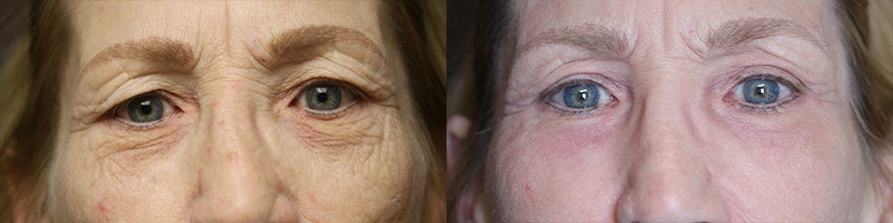 EnigmaLift - Eye Bag Removal Before & After Gallery - Patient 77043985 - Image 1