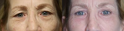 ÔPTIMized Laser Cocktail Before & After Gallery - Patient 77043979 - Image 1