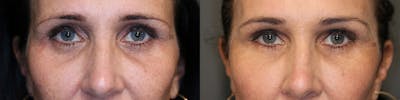 EnigmaLift - Eye Bag Removal Before & After Gallery - Patient 77043996 - Image 1