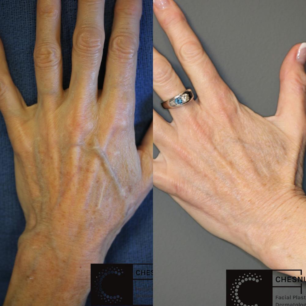 Dermal Fillers Before & After Gallery - Patient 77044013 - Image 1