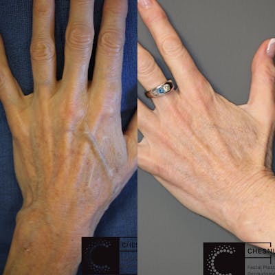 Dermal Fillers Before & After Gallery - Patient 77044013 - Image 1