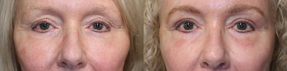  EnigmaLift - Upper Eyelid Surgery Before & After Gallery - Patient 74254025 - Image 2