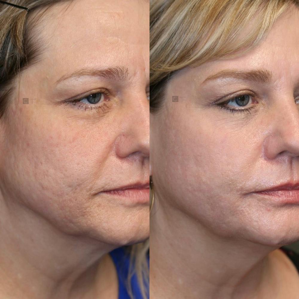 Photodynamic Acne Scar Remodeling Gallery - Patient 77044629 - Image 1
