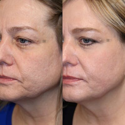 Photodynamic Acne Scar Remodeling Before & After Gallery - Patient 77044629 - Image 2