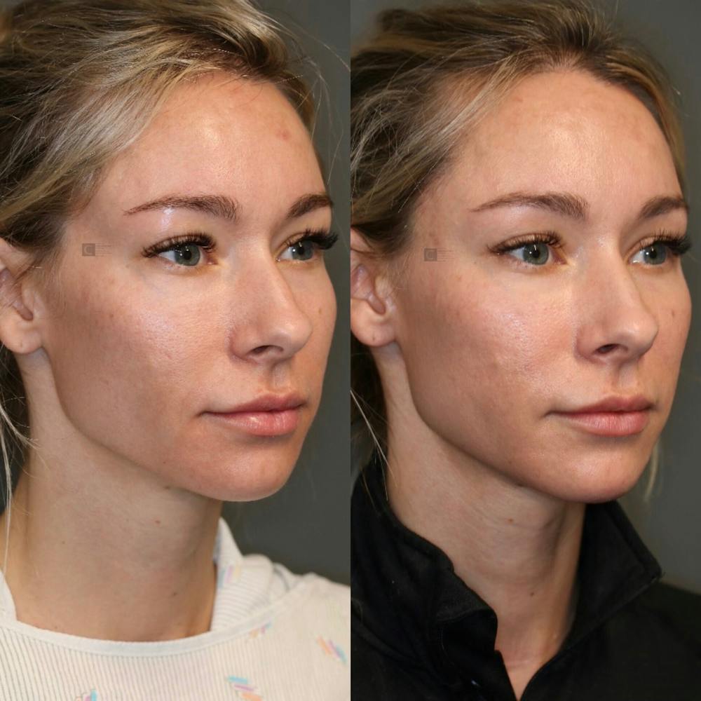 ÔPTIMized Facial Fat Transfer Before & After Gallery - Patient 77045049 - Image 2