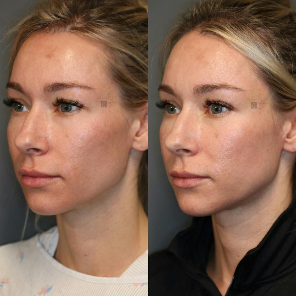 ÔPTIMized Facial Fat Transfer Before & After Gallery - Patient 77045049 - Image 3