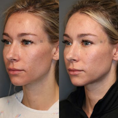 Regenerative Medicine Before & After Gallery - Patient 77045064 - Image 2