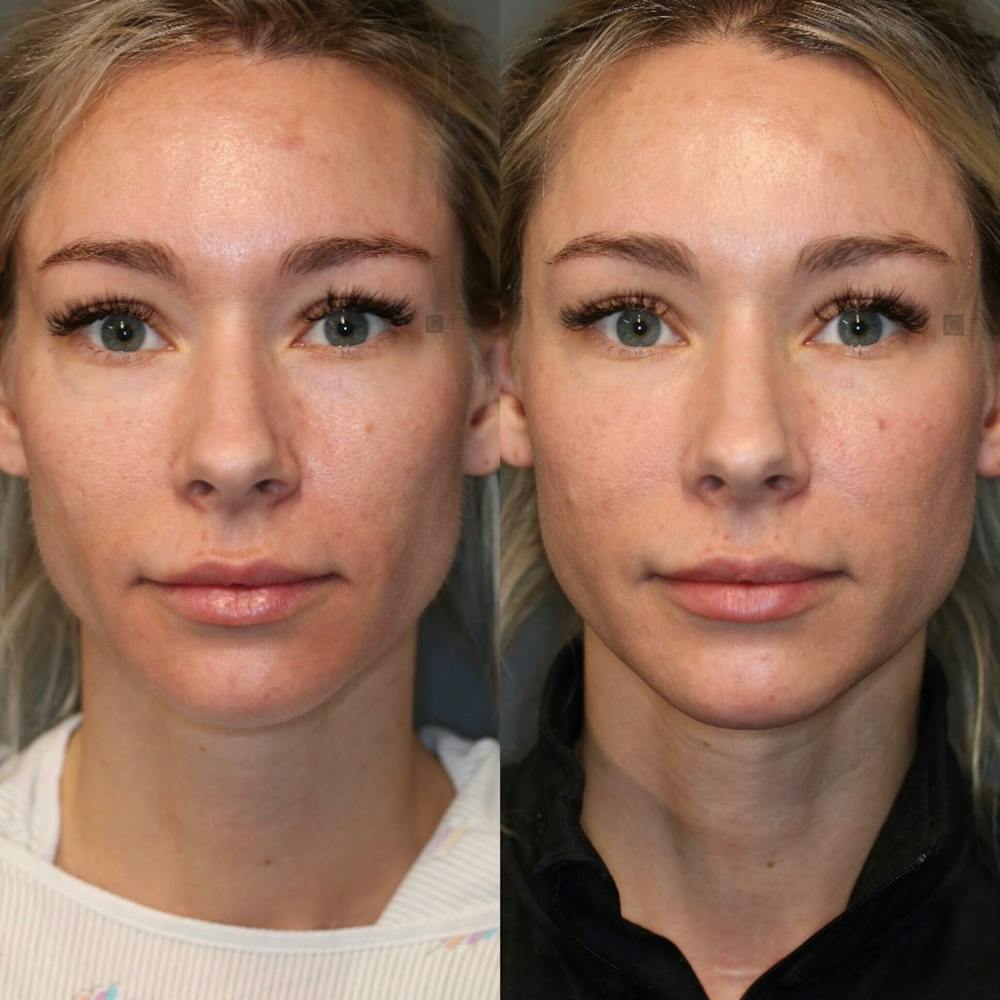 Regenerative Medicine Before & After Gallery - Patient 77045064 - Image 1