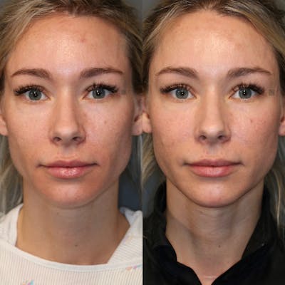 Regenerative Medicine Before & After Gallery - Patient 77045064 - Image 1