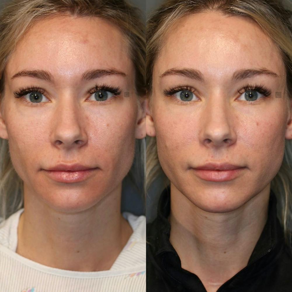 ÔPTIMized Facial Fat Transfer Before & After Gallery - Patient 77045049 - Image 1