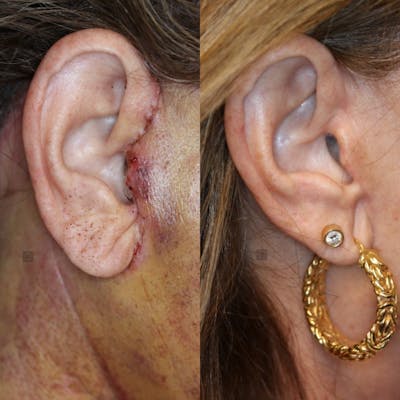 EnigmaLift - Facelift Before & After Gallery - Patient 77045070 - Image 1
