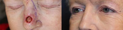 MOHS & Reconstruction Surgery Before & After Gallery - Patient 77045073 - Image 1
