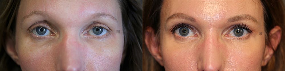 EnigmaLift - Brow Lift Before & After Gallery - Patient 77045207 - Image 1
