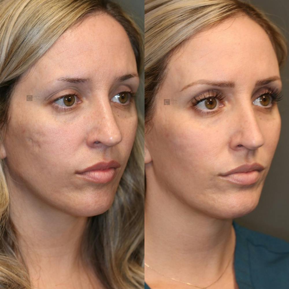 Photodynamic Acne Scar Remodeling Before & After Gallery - Patient 81572639 - Image 1