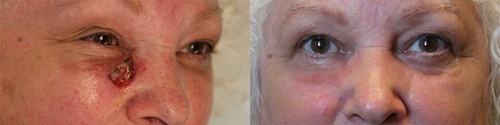 MOHS & Reconstruction Surgery Before & After Gallery - Patient 81572686 - Image 1