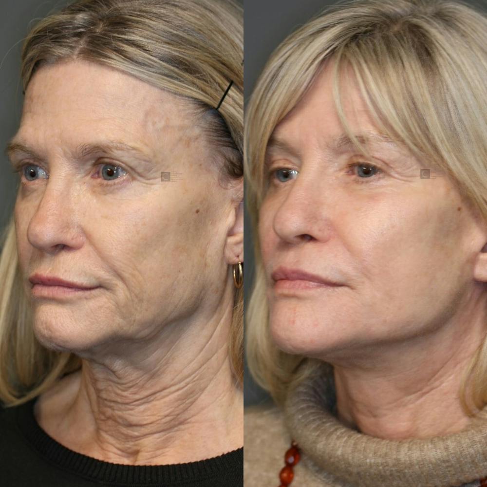EnigmaLift - Facelift Before & After Gallery - Patient 81572688 - Image 1
