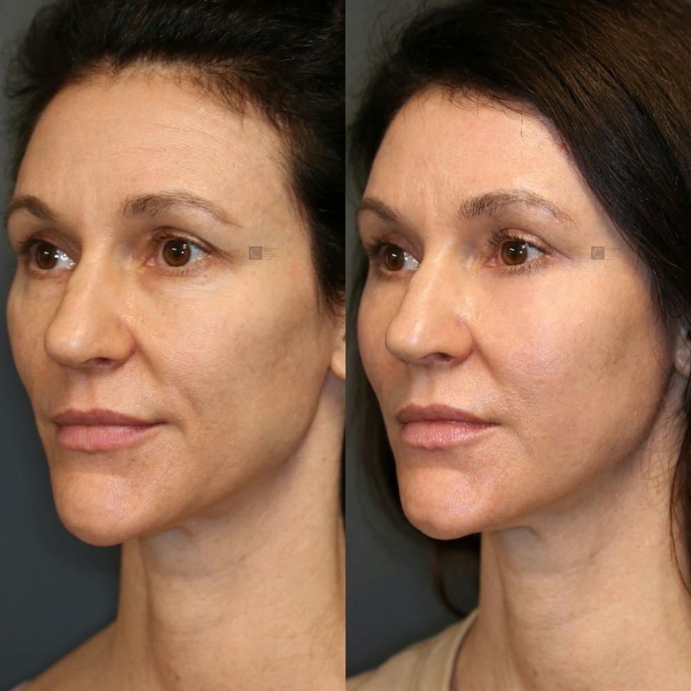 ÔPTIMized Facial Fat Transfer Before & After Gallery - Patient 81578537 - Image 1