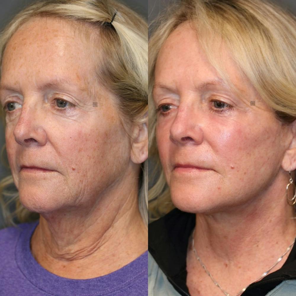 deep plane neck lift before and after picture