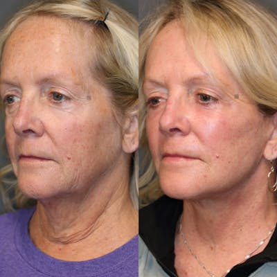 deep plane neck lift before and after picture
