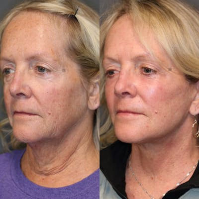 Facial Fat Transfer Before & After Gallery - Patient 81578767 - Image 1