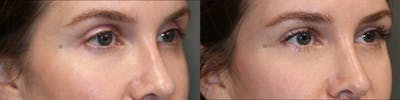  EnigmaLift - Upper Eyelid Surgery Before & After Gallery - Patient 81578865 - Image 2