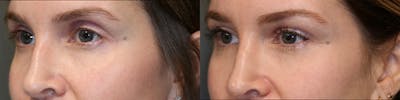 EnigmaLift - Eye Bag Removal Before & After Gallery - Patient 81589357 - Image 2