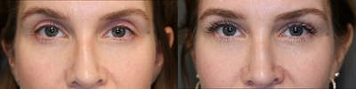 EnigmaLift - Eye Bag Removal Before & After Gallery - Patient 81589357 - Image 1