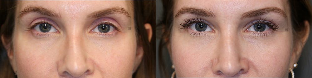  EnigmaLift - Upper Eyelid Surgery Before & After Gallery - Patient 81578865 - Image 1