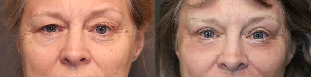 EnigmaLift - Eye Bag Removal Before & After Gallery - Patient 81589715 - Image 1