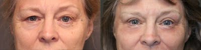  EnigmaLift - Upper Eyelid Surgery Before & After Gallery - Patient 81589716 - Image 1