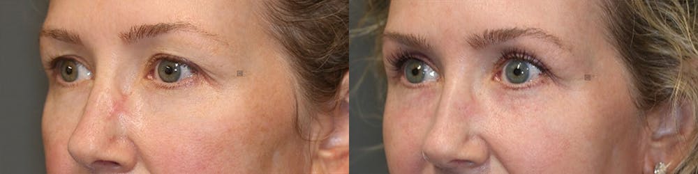 EnigmaLift - Eye Bag Removal Before & After Gallery - Patient 81589739 - Image 3