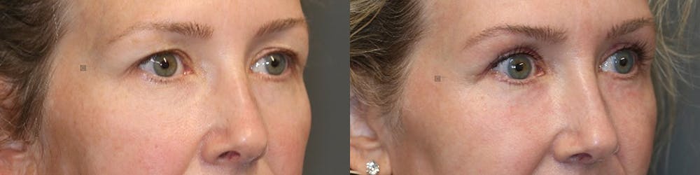 EnigmaLift - Brow Lift Before & After Gallery - Patient 81589731 - Image 3