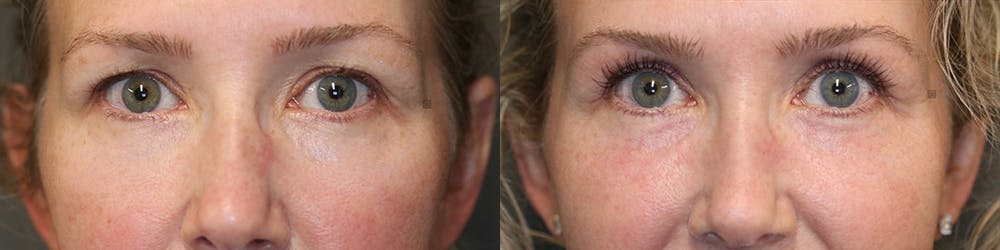 EnigmaLift - Eye Bag Removal Before & After Gallery - Patient 81589739 - Image 1