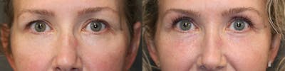  EnigmaLift - Upper Eyelid Surgery Gallery - Patient 81589755 - Image 1