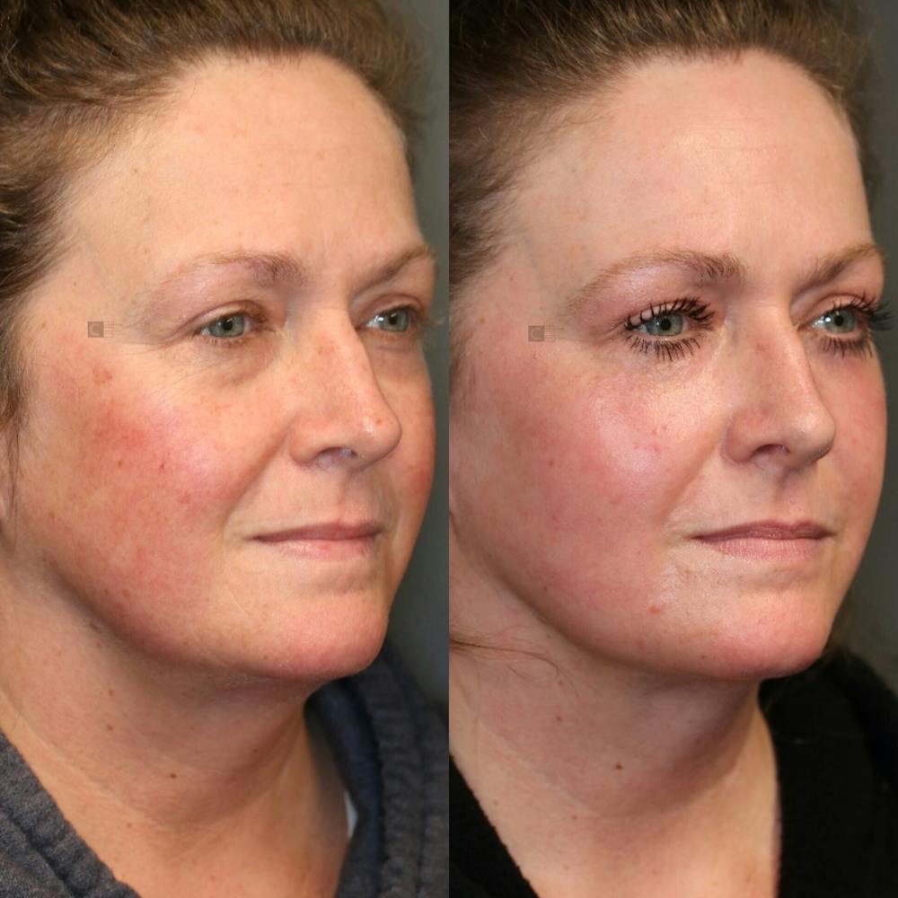 EnigmaLift - Eye Bag Removal Before & After Gallery - Patient 81589808 - Image 3