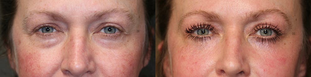 EnigmaLift - Eye Bag Removal Before & After Gallery - Patient 81589808 - Image 1