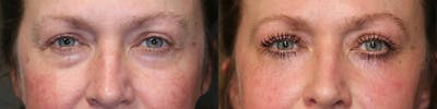  EnigmaLift - Upper Eyelid Surgery Gallery - Patient 81589793 - Image 1