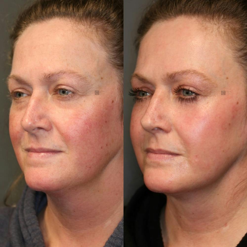  EnigmaLift - Upper Eyelid Surgery Before & After Gallery - Patient 81589793 - Image 3