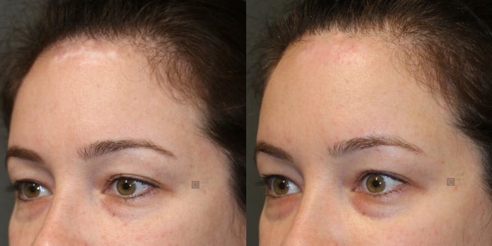 Scar Treatment Before & After Gallery - Patient 81589819 - Image 3