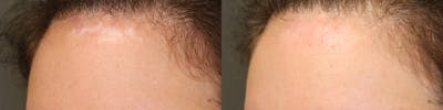 Scar Treatment Before & After Gallery - Patient 81589819 - Image 1
