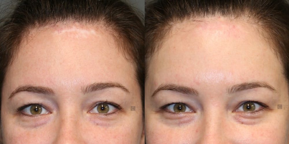 Scar Treatment Before & After Gallery - Patient 81589819 - Image 2