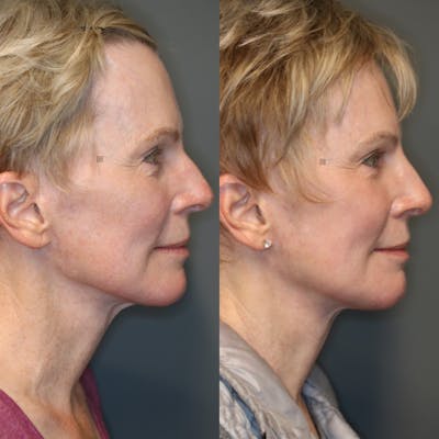 Facial Fat Transfer Before & After Gallery - Patient 114691627 - Image 1