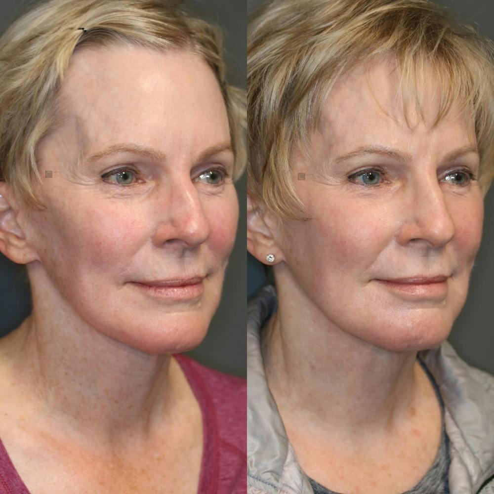 Regenerative Medicine Before & After Gallery - Patient 114691632 - Image 1