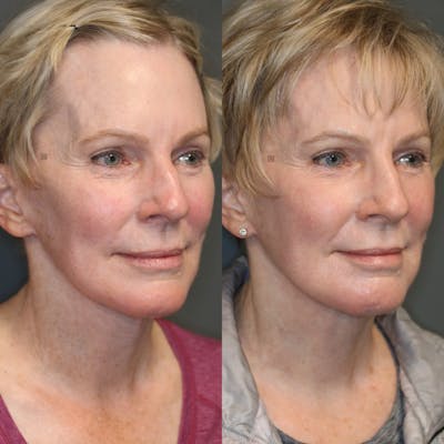 ÔPTIMized Laser Cocktail Before & After Gallery - Patient 114691638 - Image 1