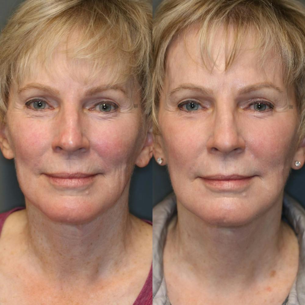 Virtuoso Lift - Neck & Jawline Tightening Before & After Gallery - Patient 114691631 - Image 3