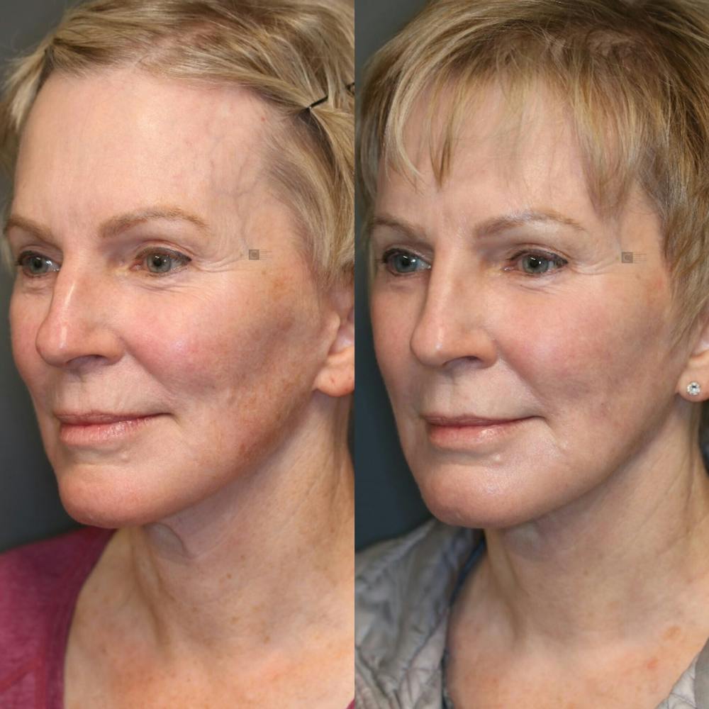 Virtuoso Lift - Neck & Jawline Tightening Before & After Gallery - Patient 114691631 - Image 4