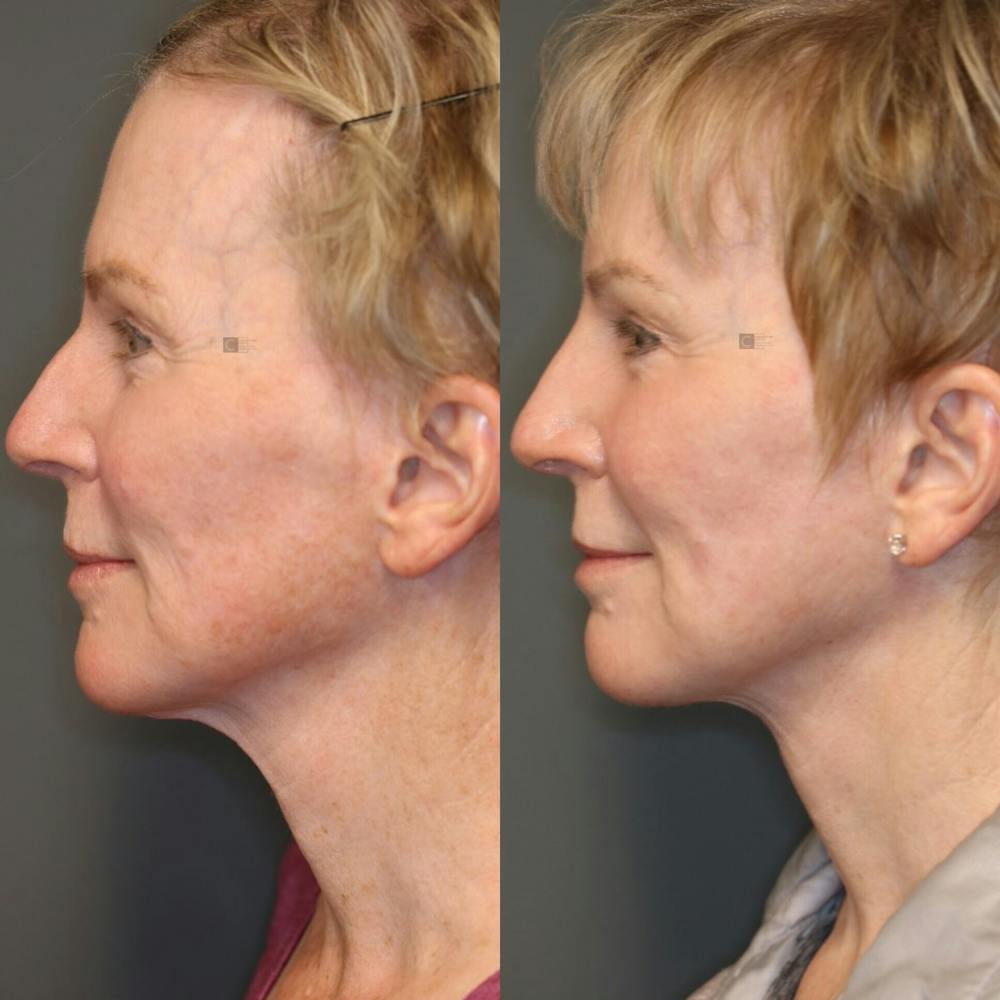 ÔPTIMized Facial Fat Transfer Before & After Gallery - Patient 114691627 - Image 5