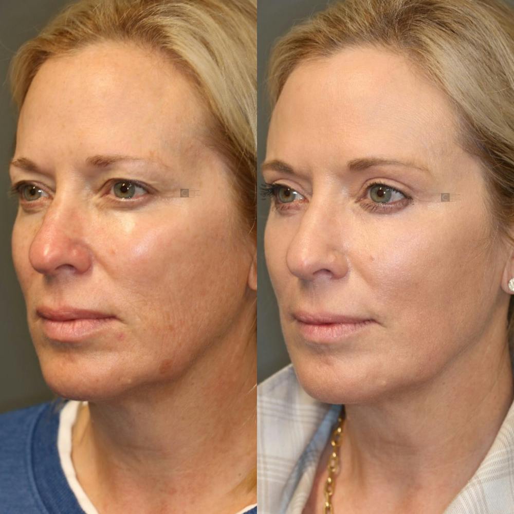 Before & After EnigmaLift Upper Eyelid Surgery