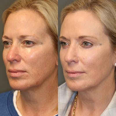 Before & After EnigmaLift Upper Eyelid Surgery